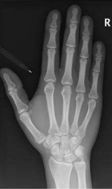 Perfect DP Hand Radiograph